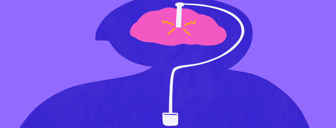 Deep Brain Stimulation device forms a question mark